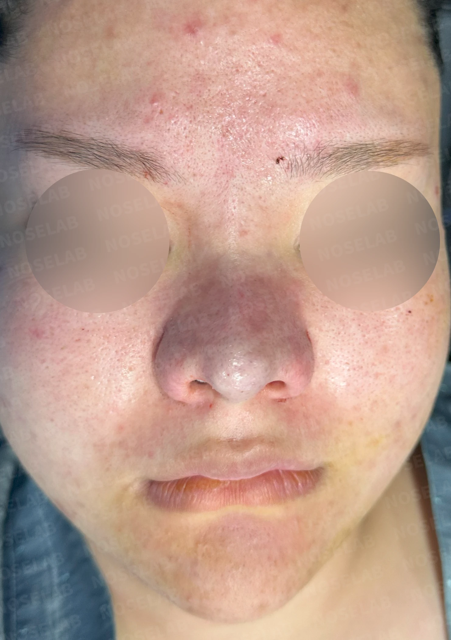 복코와 짧은 코, 비주 함몰이 함께 나타나는 이유와 코끝 입체감을 만드는 방법 — 수술 직후 0일 정면, 측면, 비스듬한 측면 사진 직후 사진은 부기가 있는 상태로 최종 결과와 다를 수 있습니다.