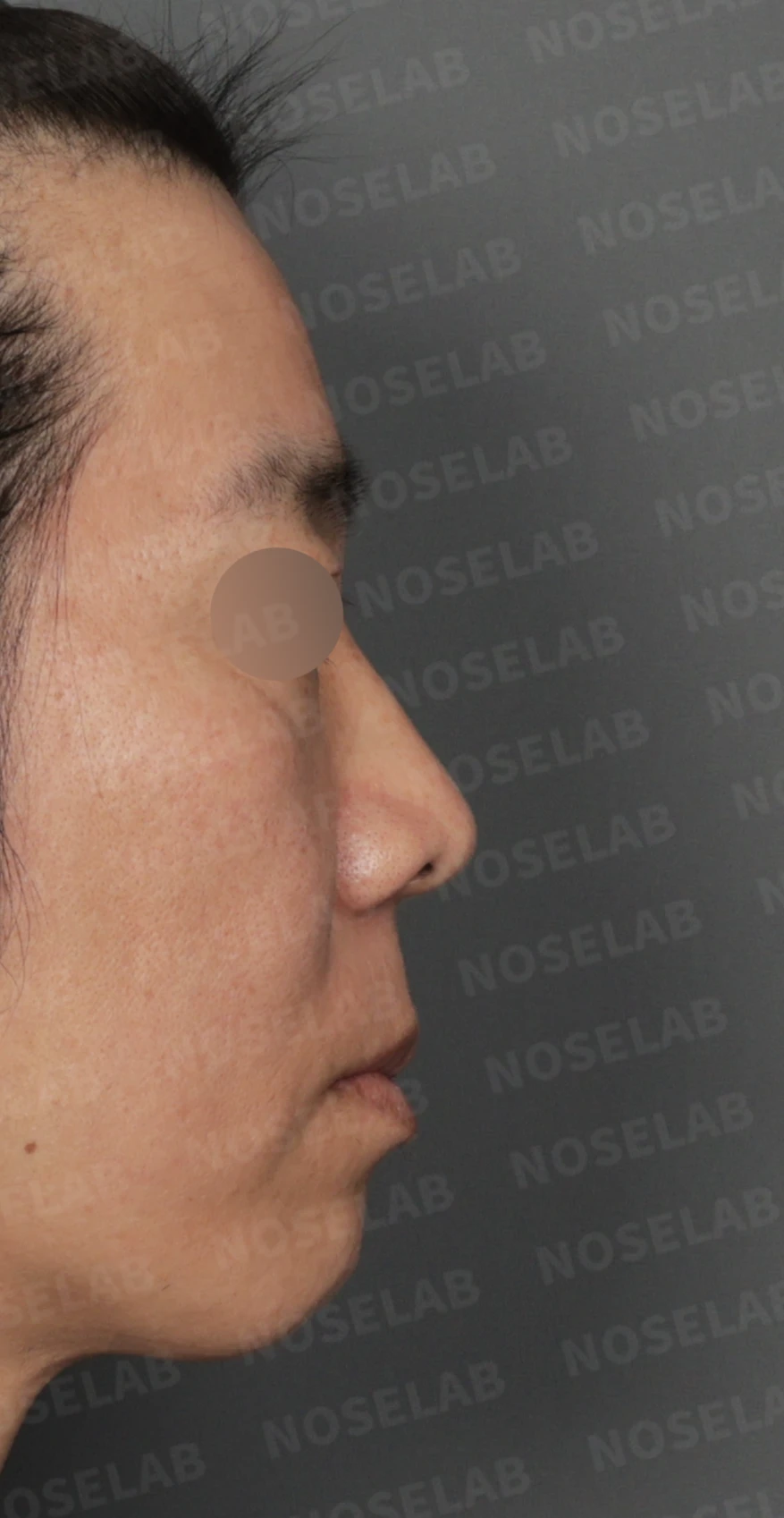 짧고 들린 코와 긴 인중, 자가늑연골로 완성한 남성스러운 직선코 — 디자인 상담 우측 비스듬한 측면, 측면, 비공 사진