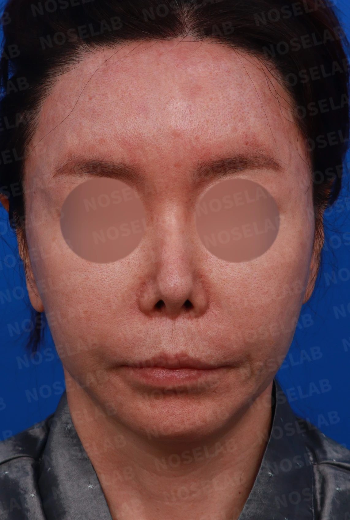 찝힌코, 들린코 자가늑연골 재건으로 교정 사례 — 디자인 상담 정면, 우측 측면, 비스듬한 측면 사진
