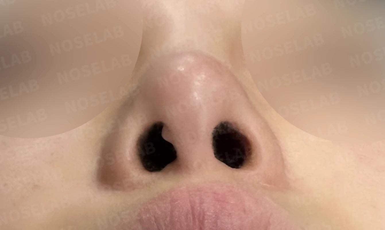 심한 비중격 만곡과 높은 콧대 시작점, 기증늑연골로 정밀 재건 — 전(좌) 직후(후)