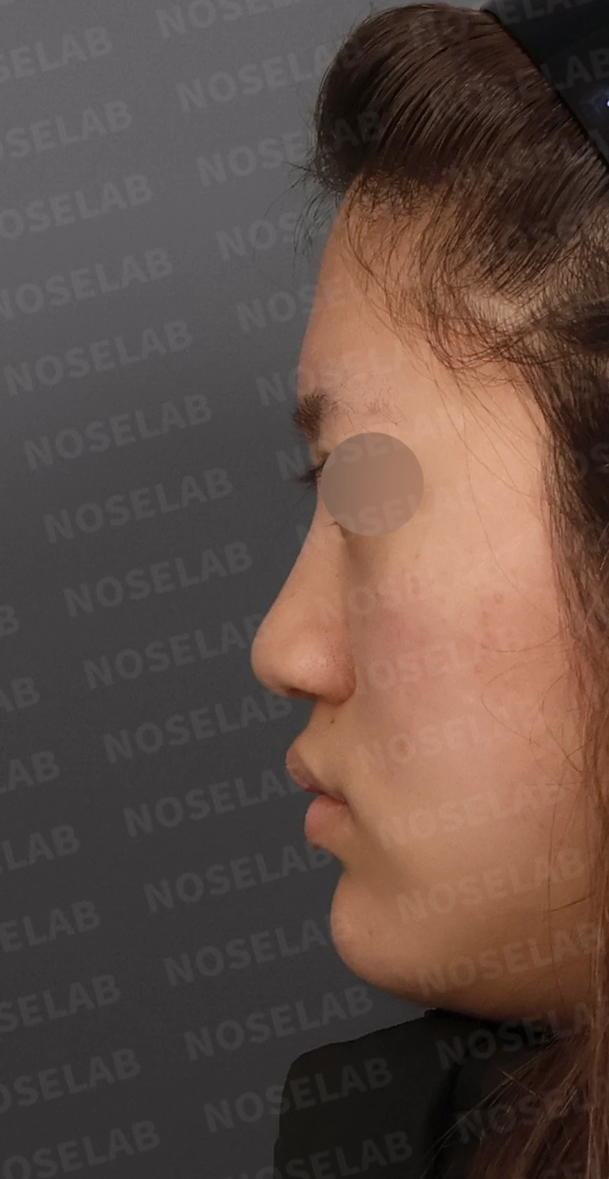 뭉툭한 코끝과 퍼진 코, 자가늑연골 비중격 연장술로 자연스럽게 교정 — 디자인 상담 정면, 좌측 측면, 비스듬한 측면 사진입니다.