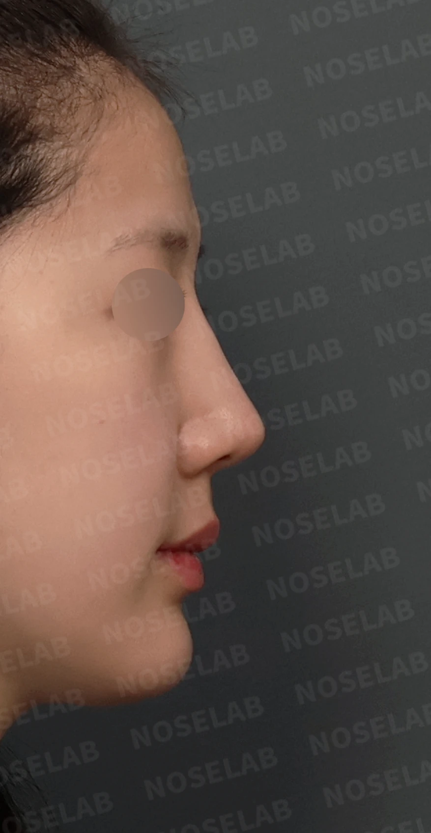 코재수술, 휘어진 코뼈와 매부리코를 외측 절골술과 자가늑연골로 자연스럽게 교정 — 디자인 상담 우측 측면, 비스듬한 측면, 비공 사진입니다.