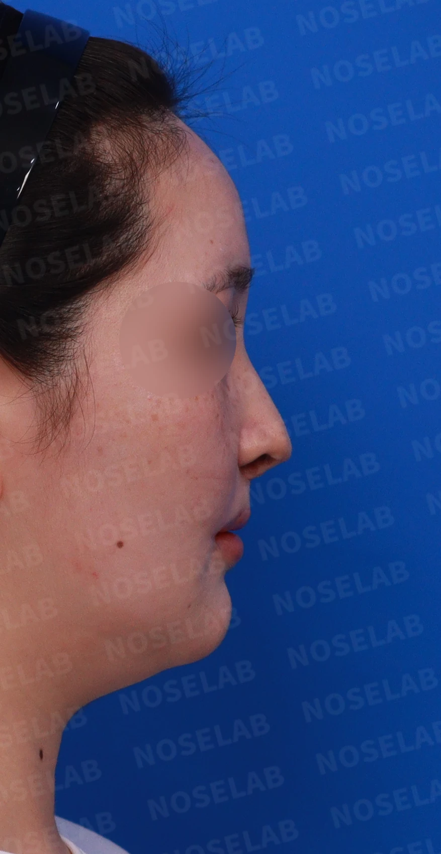 구순구개열에서 코 비대칭이 남는 이유와 늑연골·귀연골 재건 방법 — 디자인 상담 우측 측면 , 비스듬한 측면 , 비공 사진입니다.
