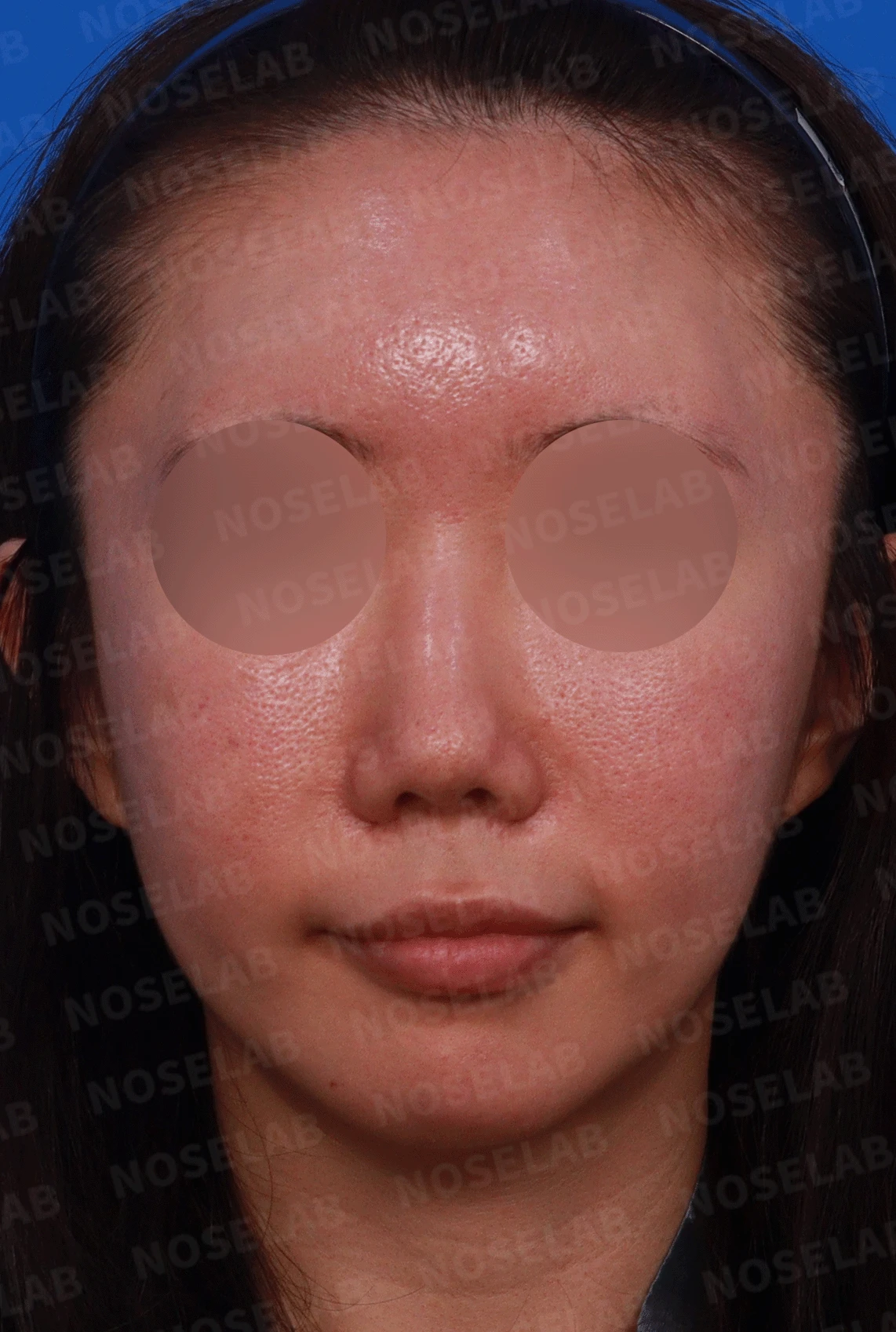 오래된 코 수술 뒤 비주가 함몰되고 코끝이 뭉툭해지는 이유와 재건 방법 — 디자인 상담 정면, 좌측 비스듬한 측면, 측면 사진