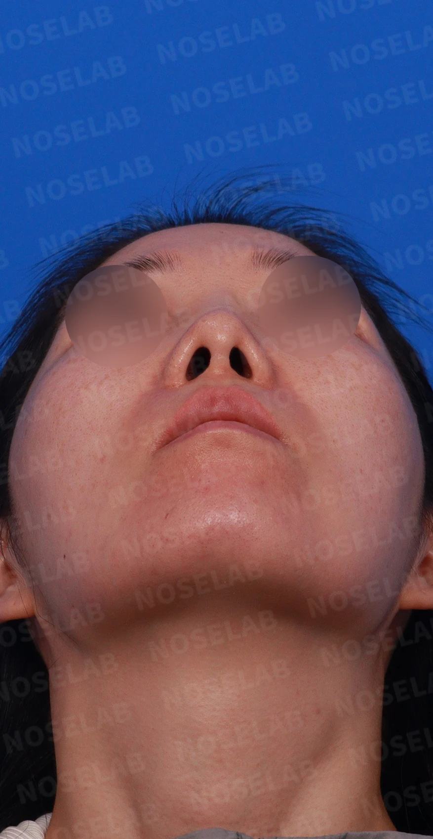 콧대 시작점이 높고 코가 휘어 보이는 이유, 자가 늑연골 교정은 어떻게 하나 — 디자인 상담 우측 측면 , 비스듬한 측면 , 비공 사진입니다.
