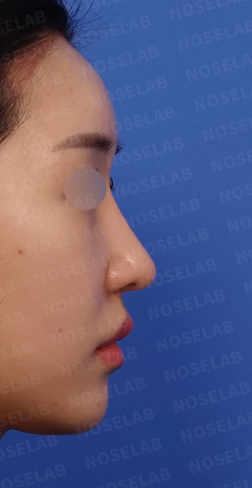 화살코와 복코가 함께 있는 코, 비중격 재건부터 시작하는 이유 — 디자인 상담 우측 측면, 비스듬한 측면, 비공 사진입니다.