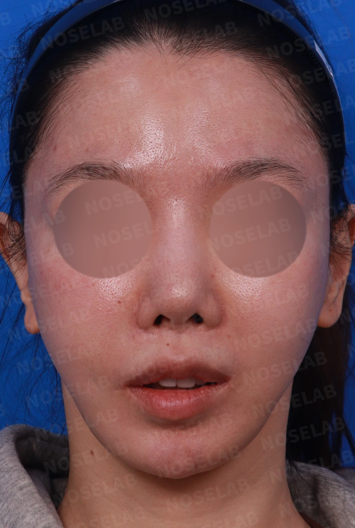 콧대가 뭉툭하게 퍼져 보이는 만성 이물 반응, 원인과 재건 방법 — 디자인 상담 정면, 좌측 측면, 비스듬한 측면 사진
