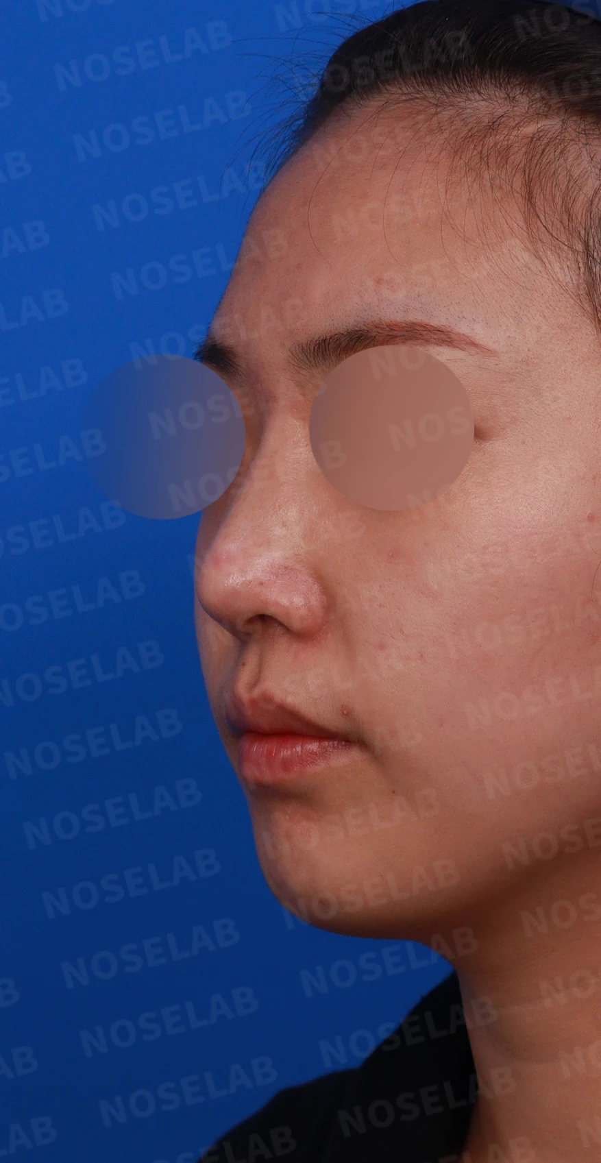 휘어진 코 교정과 비염 개선 - 자가늑연골 재건술 후기 — 디자인 상담 정면, 좌측 측면, 비스듬한 측면 사진