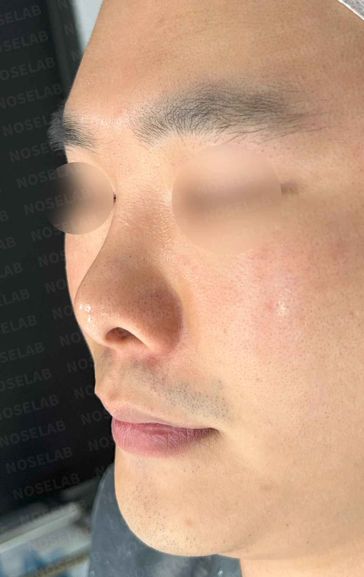 비중격 연골을 많이 쓴 코가 들리고 막히는 이유, 재건은 어떻게 하나 — 수술 전 / 수술 직후 0일 직후 사진은 부기가 있는 상태로 최종 결과와 다를 수 있습니다.