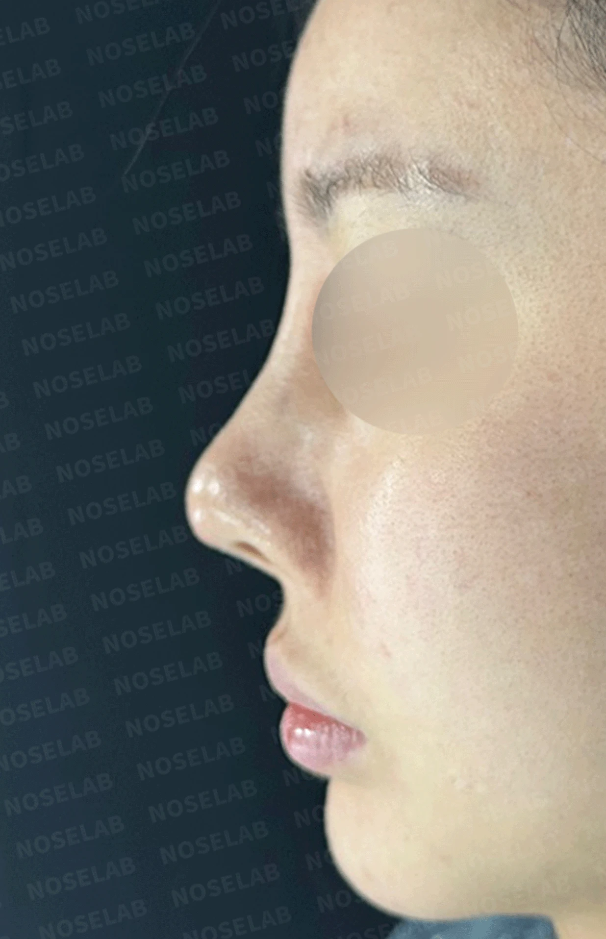 실리콘 보형물이 코끝 피부를 뚫고 나오려 할 때, 왜 생기고 어떻게 재건하나 — 수술 전 / 수술 직후 0일 직후 사진은 부기가 있는 상태로 최종 결과와 다를 수 있습니다.