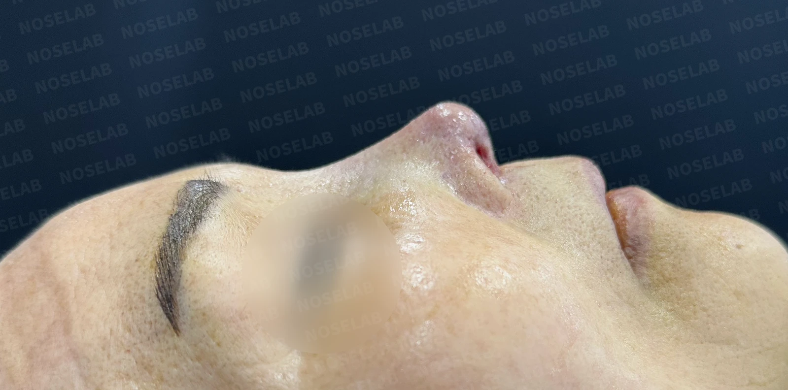 비중격 천공이 있는 코의 재수술 계획 — 수술 전 / 수술 직후 0일 직후 사진은 부기가 있는 상태로 최종 결과와 다를 수 있습니다.