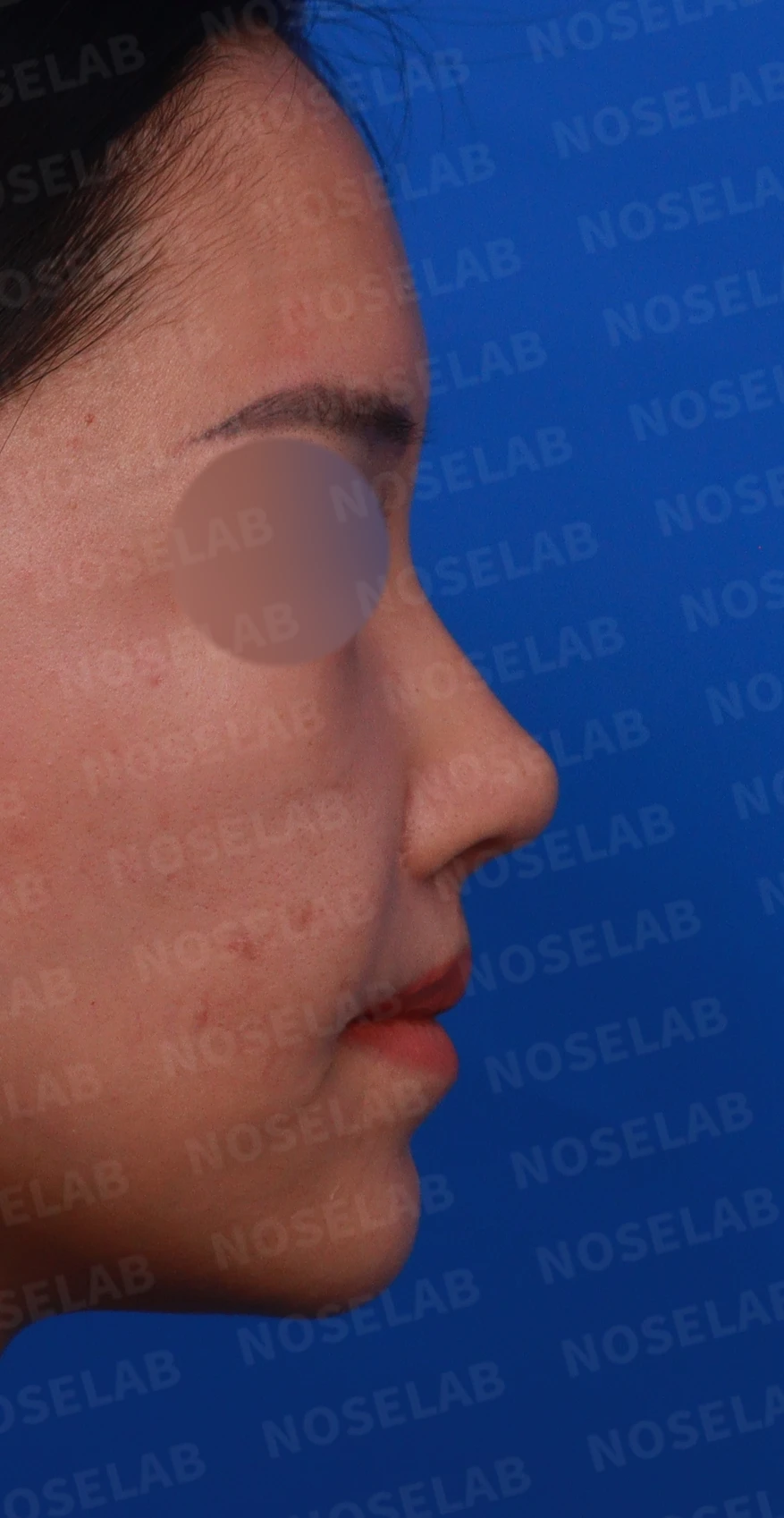 원하는 코 모양과 현재 구조를 함께 살펴보는 수술 계획 — 디자인 상담 우측 측면, 비스듬한 측면, 비공 사진입니다.