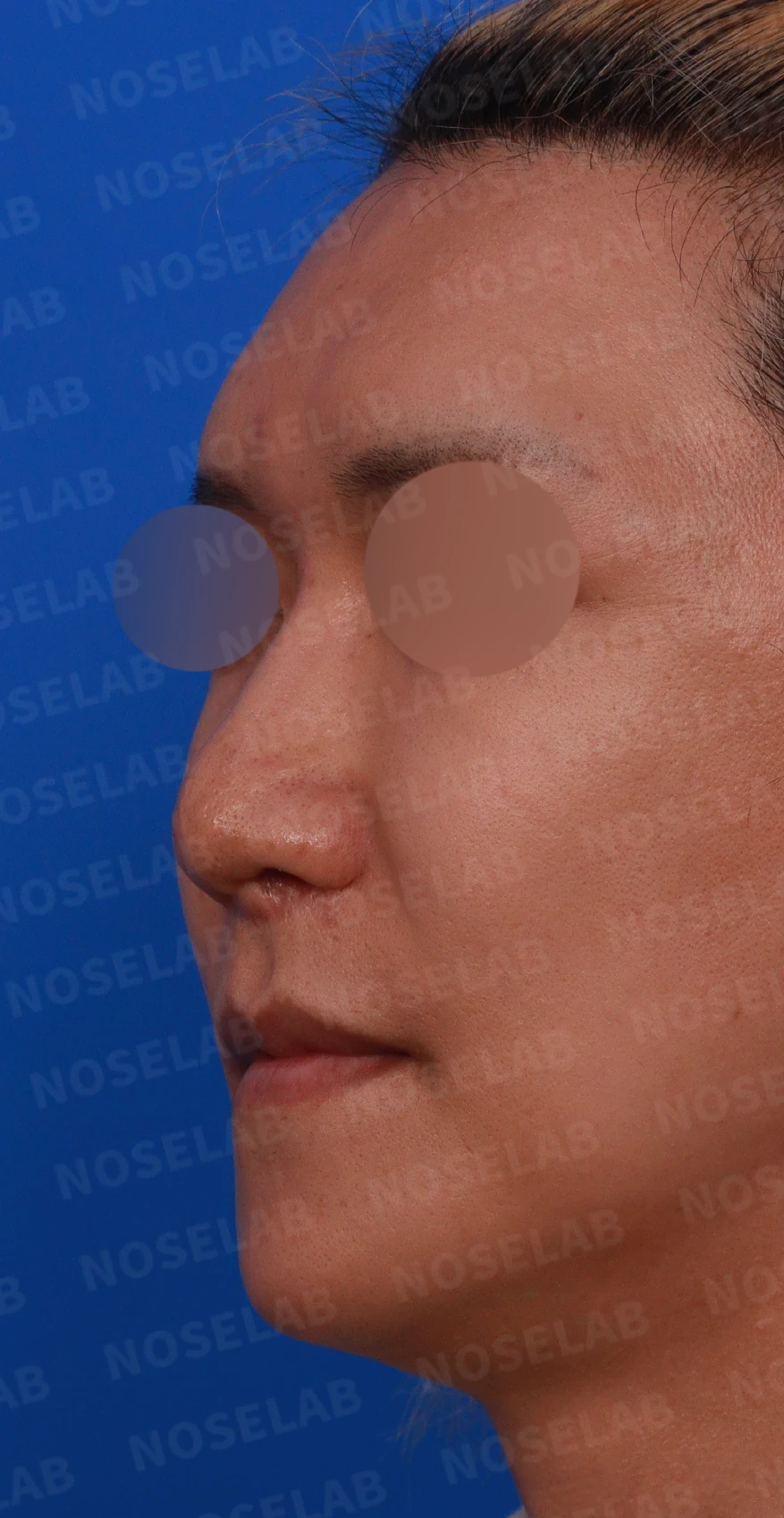 MRSA 감염 후 구축코의 구조와 재건 방법 — 수술전 디자인 상담 정면, 좌측 비스듬한 측면, 좌측 측면