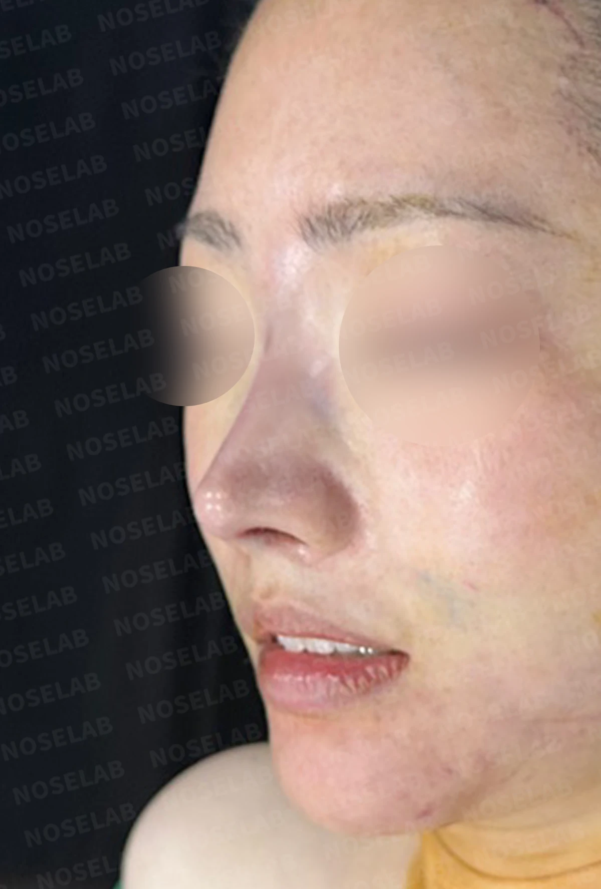 재수술한 코가 휘어 보이고 코끝이 처지는 이유 — 수술 직후 0일 정면, 측면, 비스듬한 측면 사진 직후 사진은 부기가 있는 상태로 최종 결과와 다를 수 있습니다.