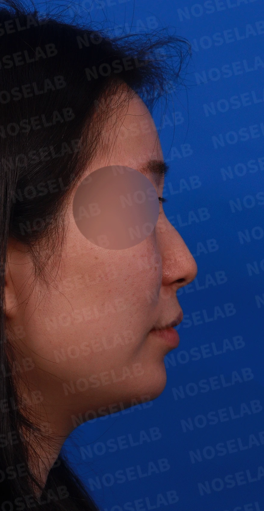 매부리코와 휜 코에 코막힘이 함께 오는 이유, 복합 교정은 어떻게 하나 — 디자인 비스듬한 측면, 측면, 비공 사진입니다.
