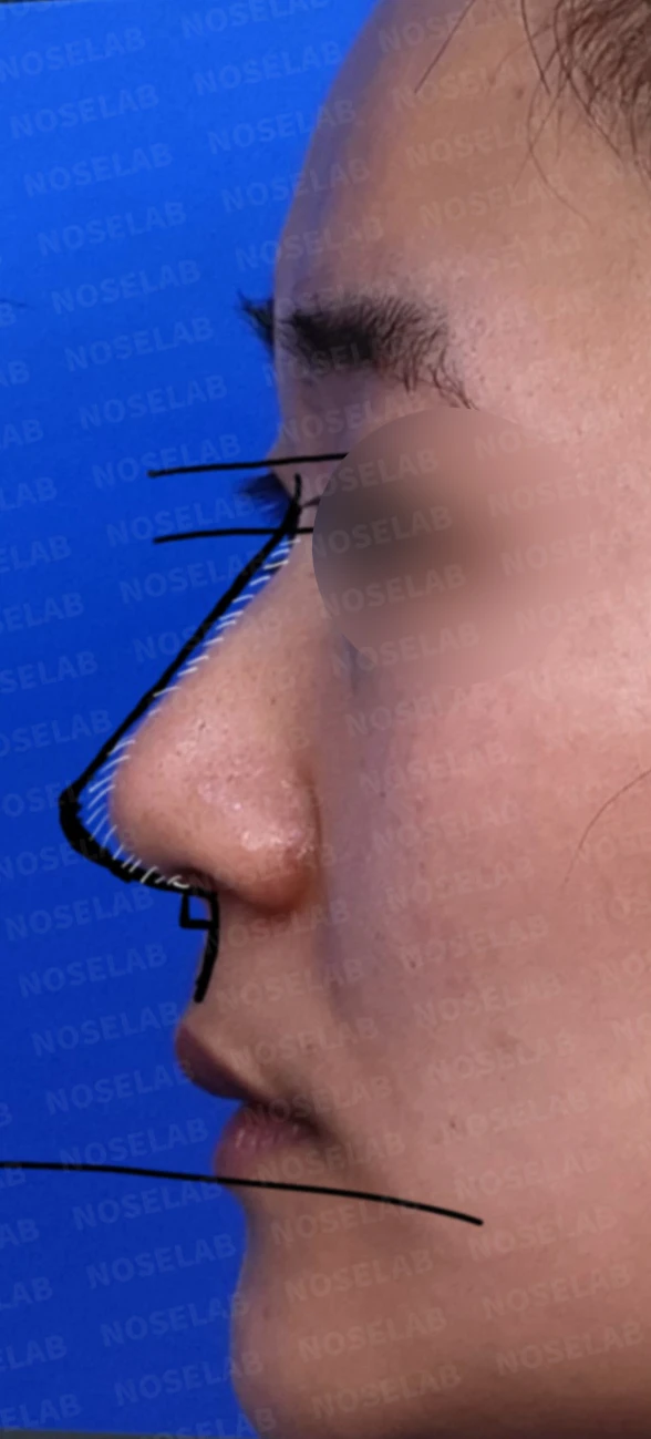 복코 수술은 어떻게 하나요? — 수술전 디자인 상담때 찍은 측면 사진입니다.