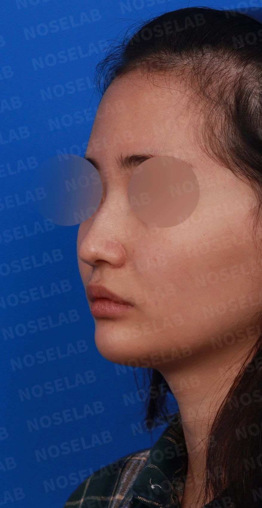 웃을 때만 화살코가 되는 이유와 코끝 연골 교정 방법 — 디자인 상담 정면, 좌측 측면, 비스듬한 측면 사진입니다.