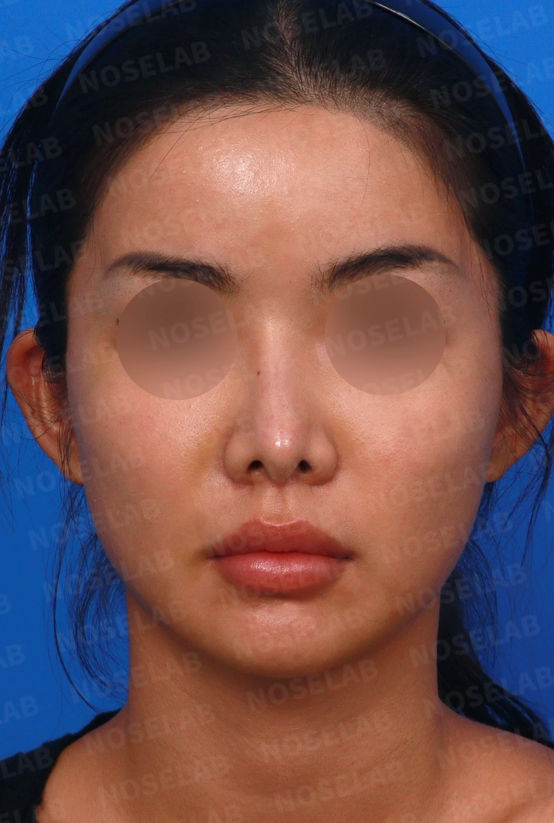 코성형 뒤 코끝이 처지고 웃을 때 퍼지는 이유, 이물질 제거와 코끝 교정 방법 — 디자인 상담 정면, 좌측 측면, 비스듬한 측면 사진입니다.