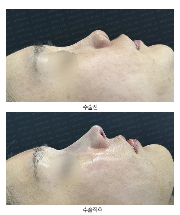코에 주입된 칼슘필러의 제거와 재건 방법 — 본문 사진 17