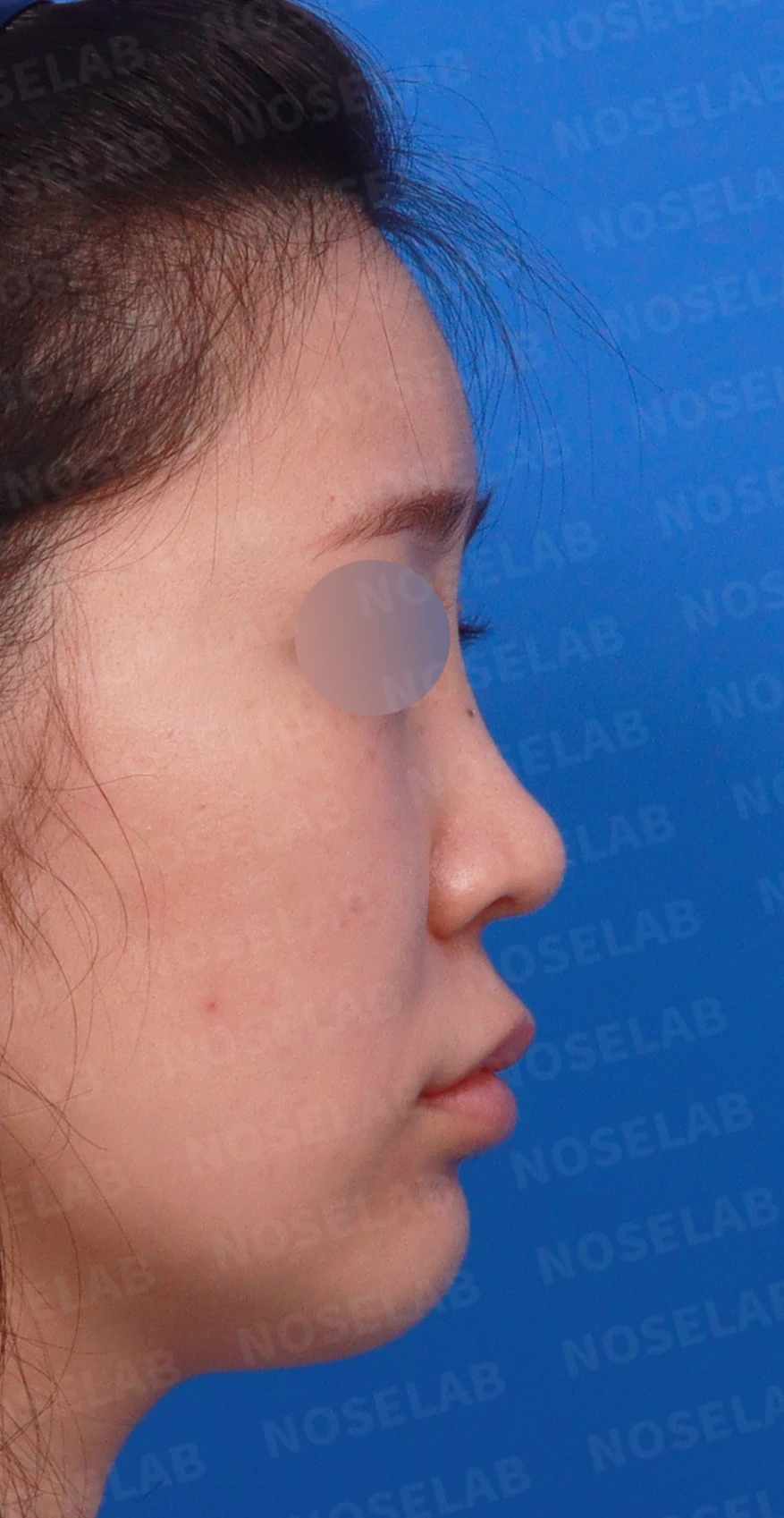 연골 노출 복원과 날개 연골 재건으로 안전하고 자연스러운 코 — 디자인 상담 우측 측면, 비스듬한 측면, 비공 사진입니다.