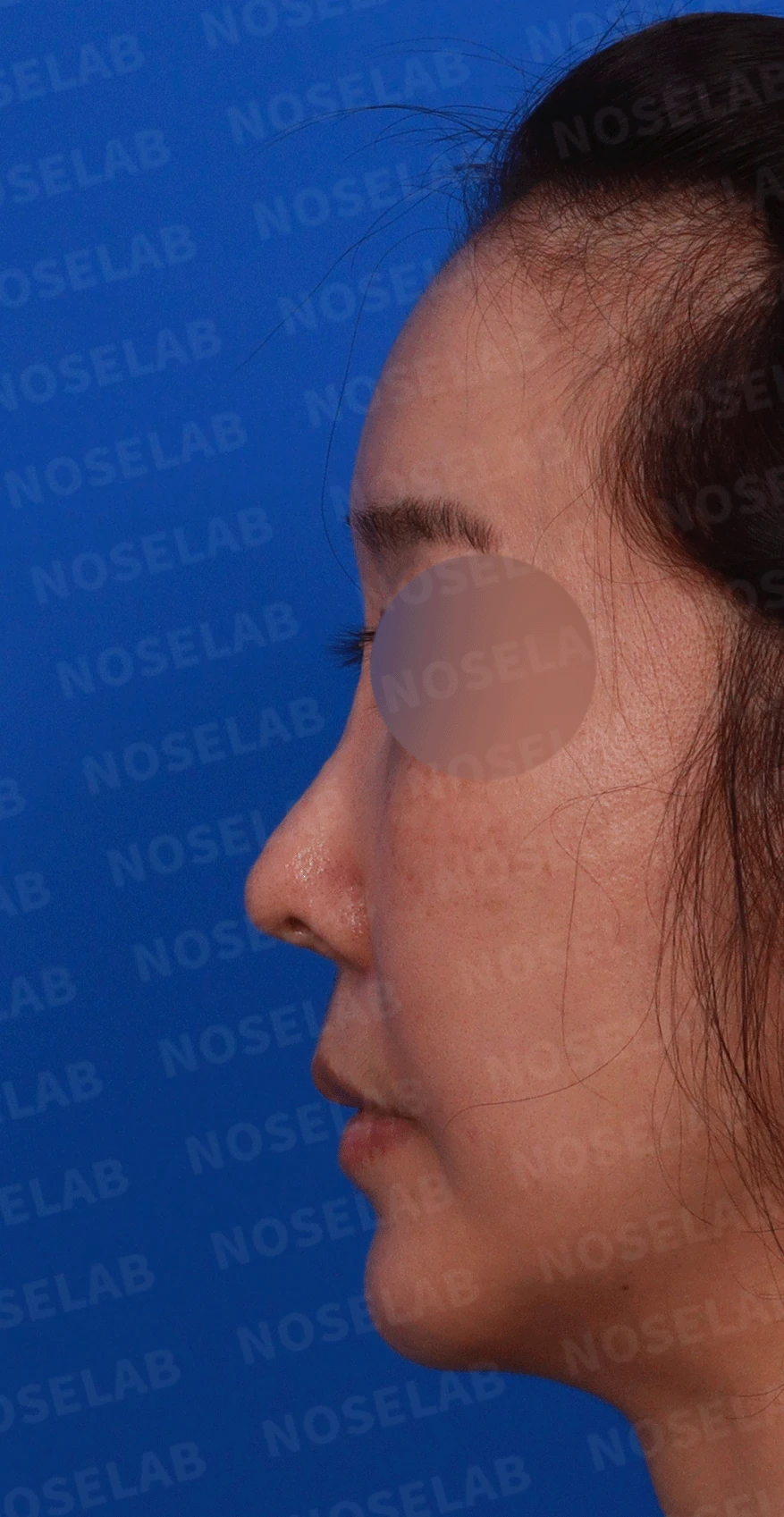 반복된 코재수술 뒤 안장코와 비밸브 협착이 생기는 이유, 전체 재건은 어떻게 하나 — 수술전 디자인 상담 정면 , 좌측 비스듬한 측면 , 측면 사진입니다.