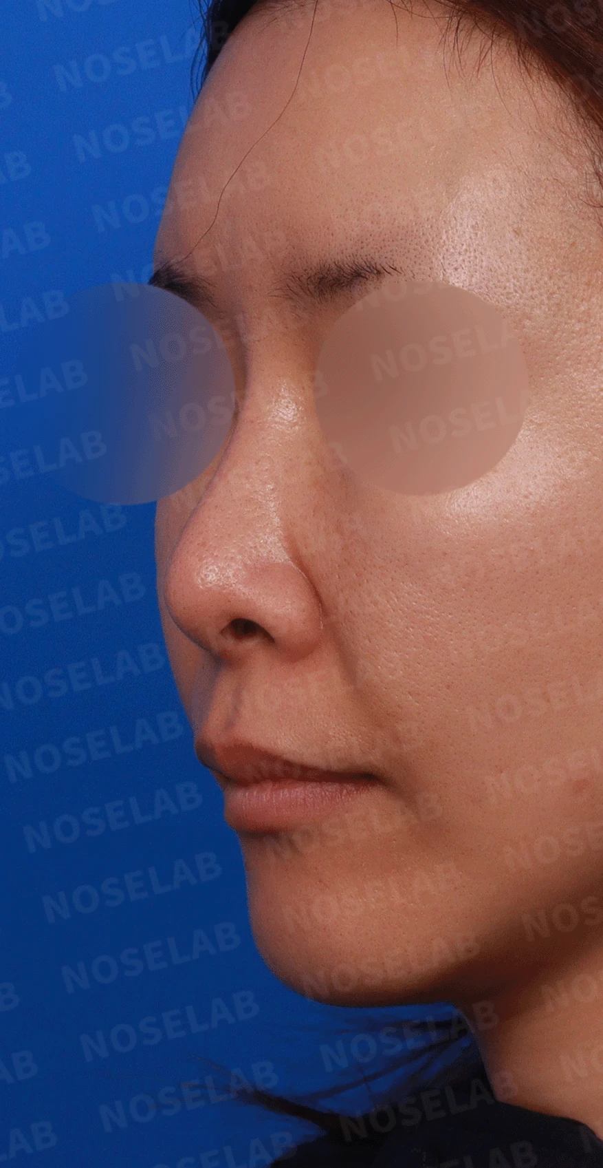 후비루와 코끝 처짐이 함께 나타나는 이유, 비중격 연장과 기능 수술은 어떻게 하나 — 디자인 상담 정면 , 좌측 측면 ,비스듬한 측면 사진
