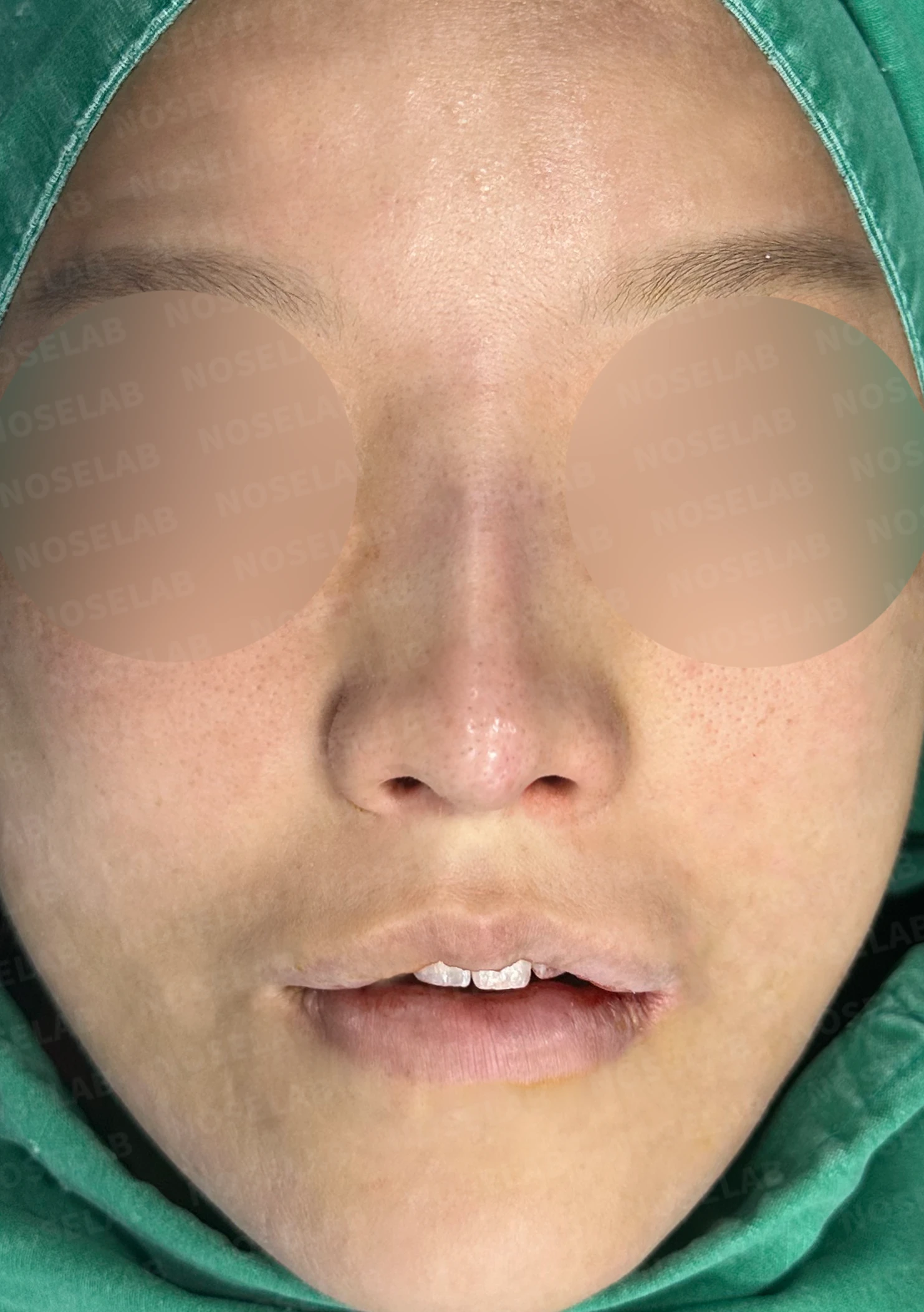 휜 코 교정과 코막힘 개선, 두 마리 토끼를 잡은 성공 사례 — 전(좌) , 직후(후)
