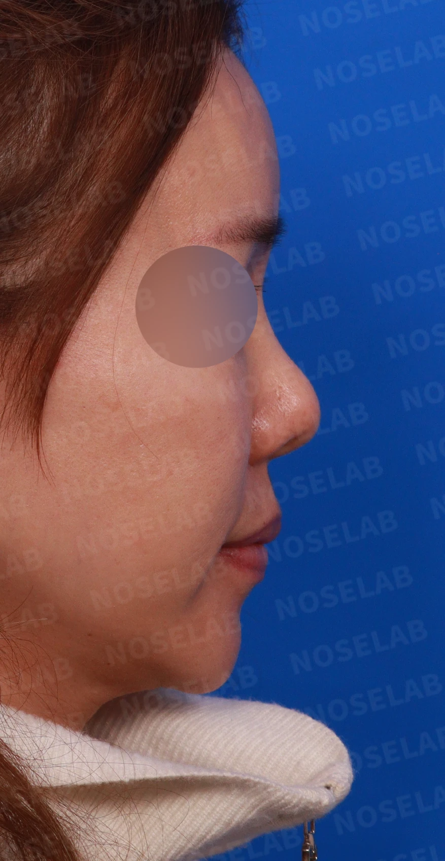 보형물을 제거한 뒤 콧대가 꺼지고 퍼지는 이유, 재건은 어떻게 하나 — 디자인 상담 우측 비스듬한 측면, 측면, 비공 사진