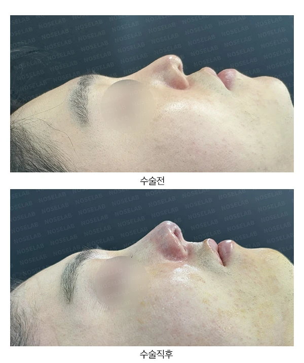 비중격연골 손상으로 무너진 코 수술 방법 — 전후 비교