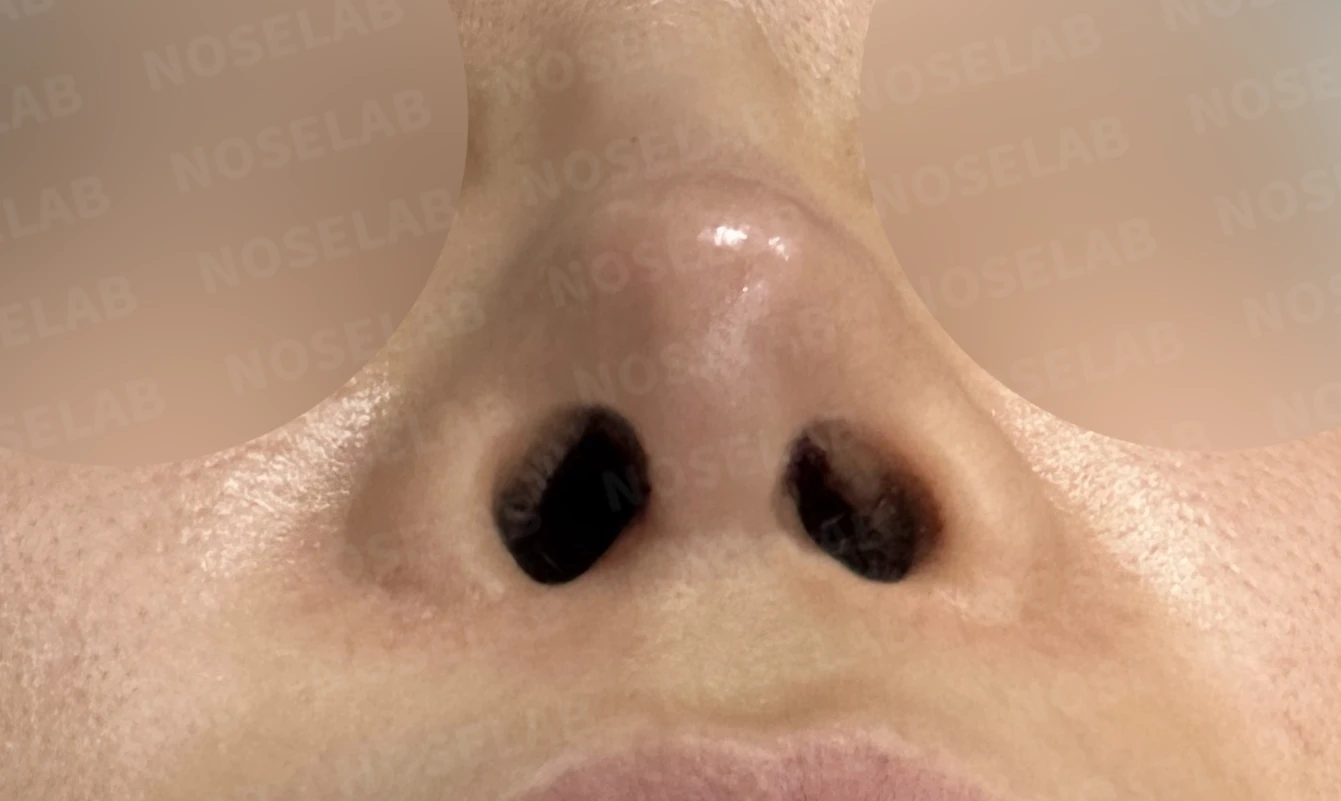 비중격 완전 재건으로 오똑한 코끝과 비공 비대칭 교정 — 전(좌) , 직후(후)