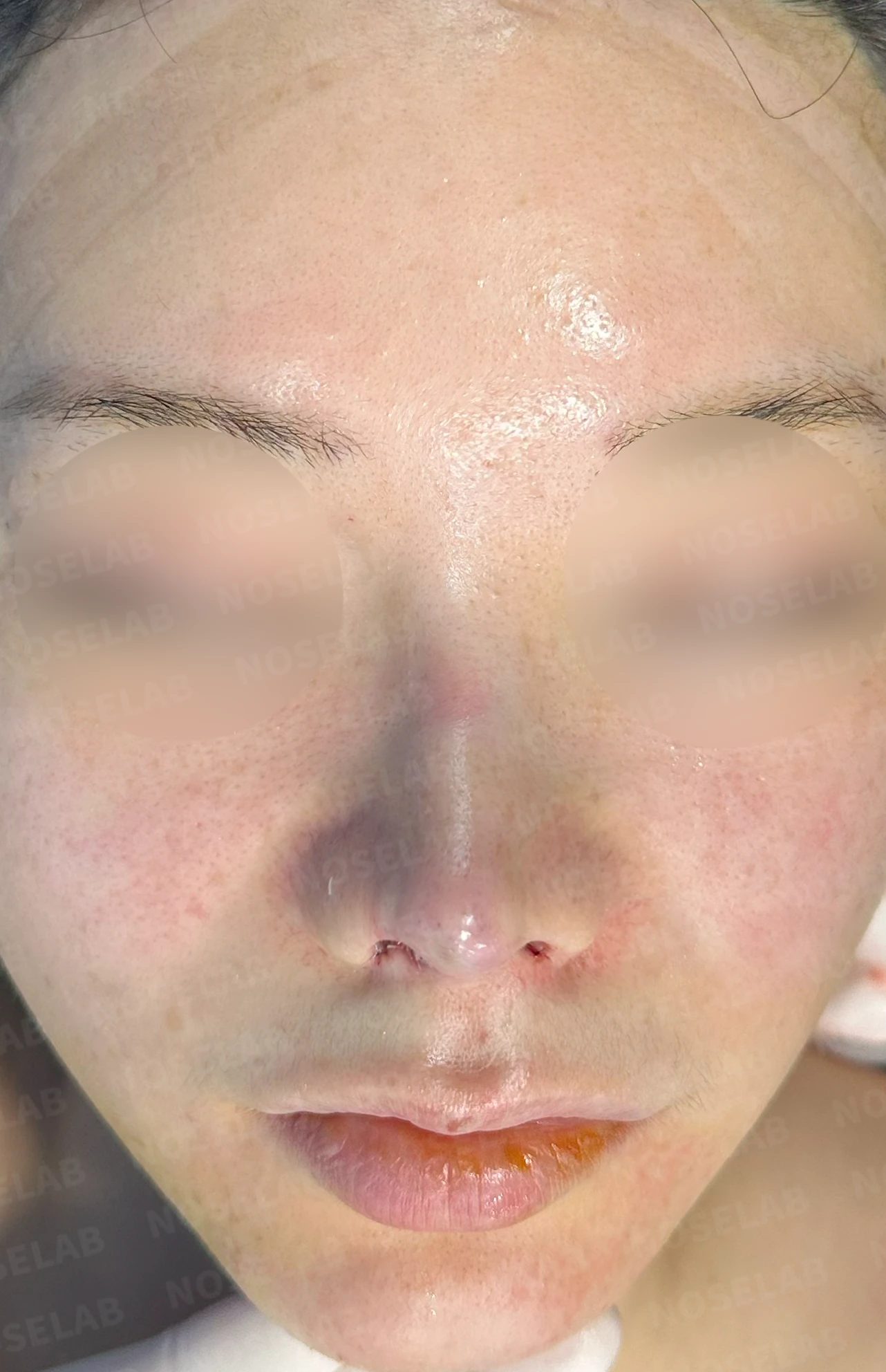 코끝 피부 상태와 괴사 위험을 고려한 재수술 계획 — 수술 직후 0일 사진 정면, 측면, 비스듬한 측면 입니다. 직후 사진은 부기가 있는 상태로 최종 결과와 다를 수 있습니다.
