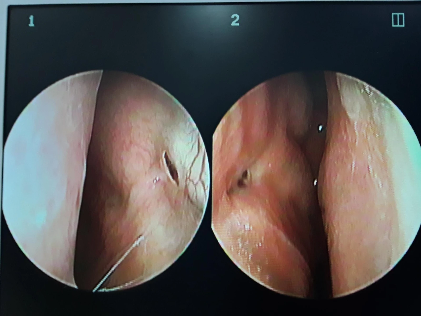 오래된 고어텍스 구축과 비중격 천공이 생기는 이유, 재건은 어떻게 하나 — 비내시경사진 비중격천공(+)