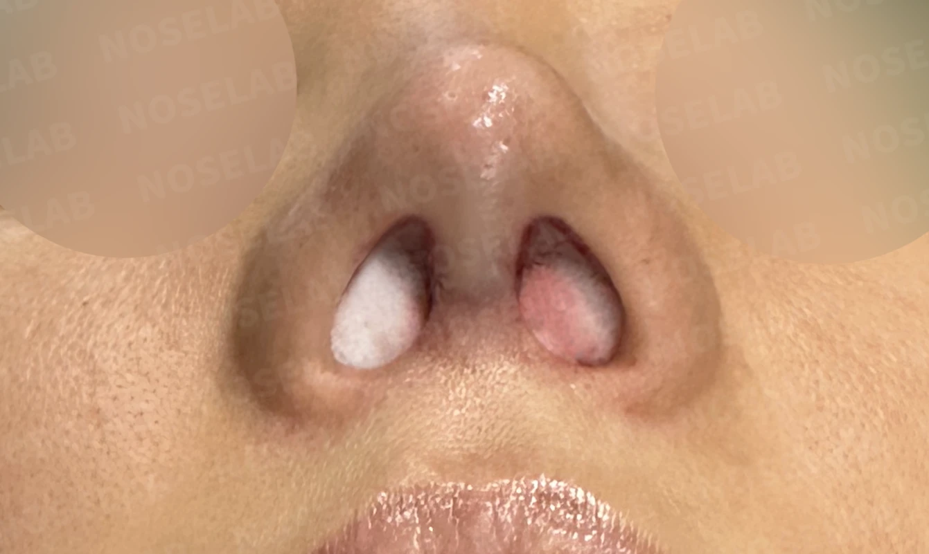 여러 번의 코재수술 뒤 비중격이 무너지는 이유, 자가늑연골 전면 재건은 어떻게 하나 — 수술 직후 0일 비공 사진입니다. 직후 사진은 부기가 있는 상태로 최종 결과와 다를 수 있습니다.