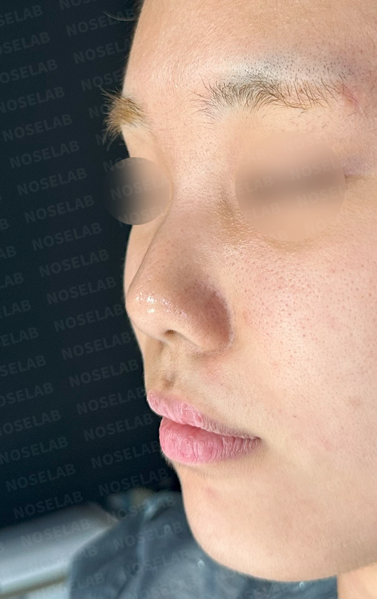 작고 뭉툭한 코는 어디까지 높일 수 있나 — 피부의 한계와 재건 방법 — 수술 전 / 수술 직후 0일 직후 사진은 부기가 있는 상태로 최종 결과와 다를 수 있습니다.