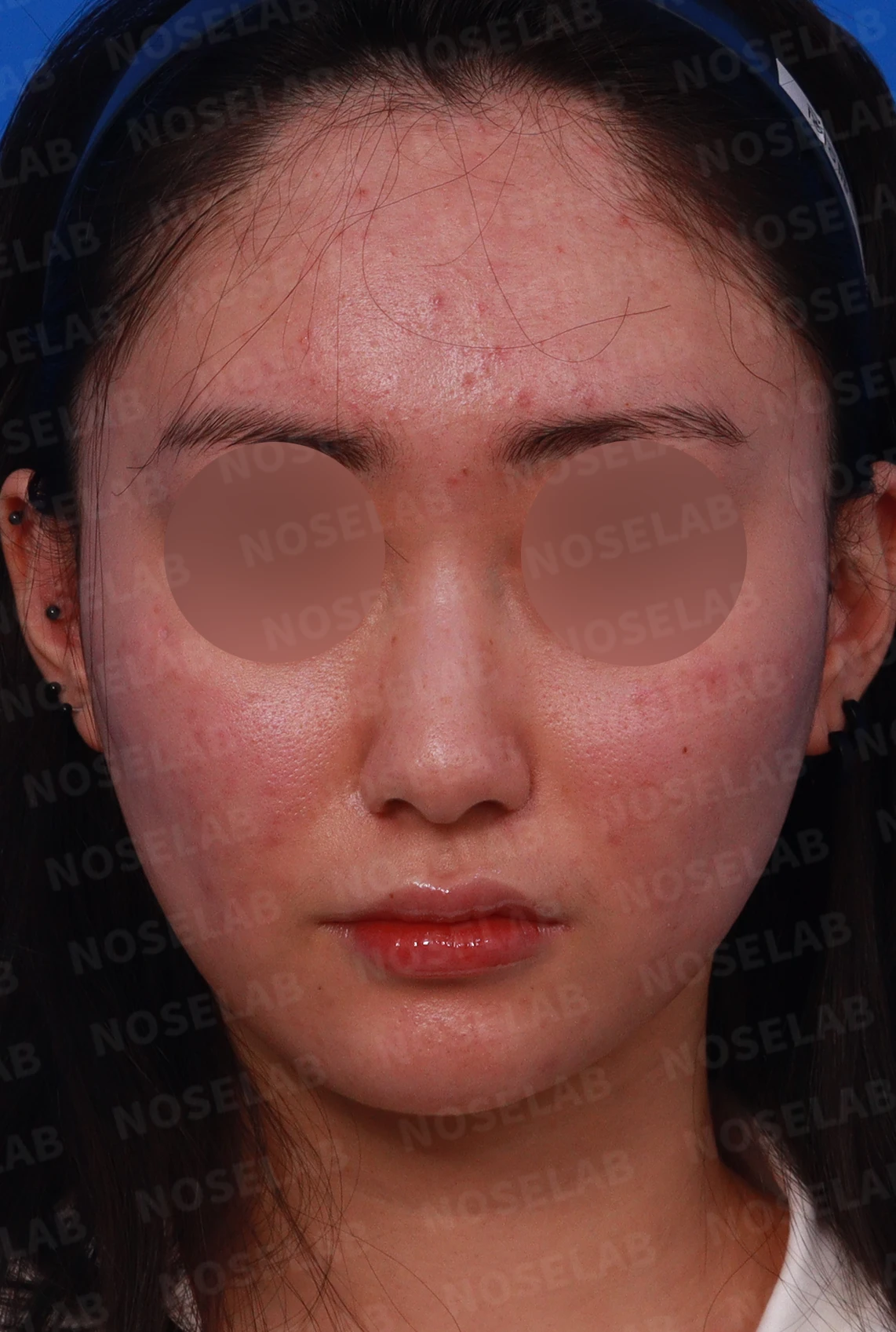 코끝이 뭉툭하게 퍼지고 코가 휘어 보이는 이유, 늑연골 재건은 어떻게 하나 — 디자인 상담 정면 , 좌측 비스듬한 측면 , 측면 사진입니다.