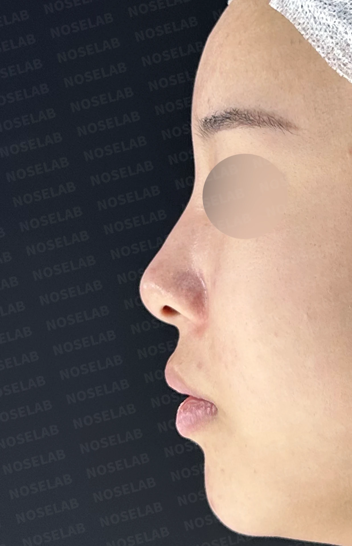 콧대가 넓고 단차져 보이는 이유, 절골술과 늑연골 코끝 성형은 어떻게 하나 — 수술 전 / 수술 직후 0일 직후 사진은 부기가 있는 상태로 최종 결과와 다를 수 있습니다.