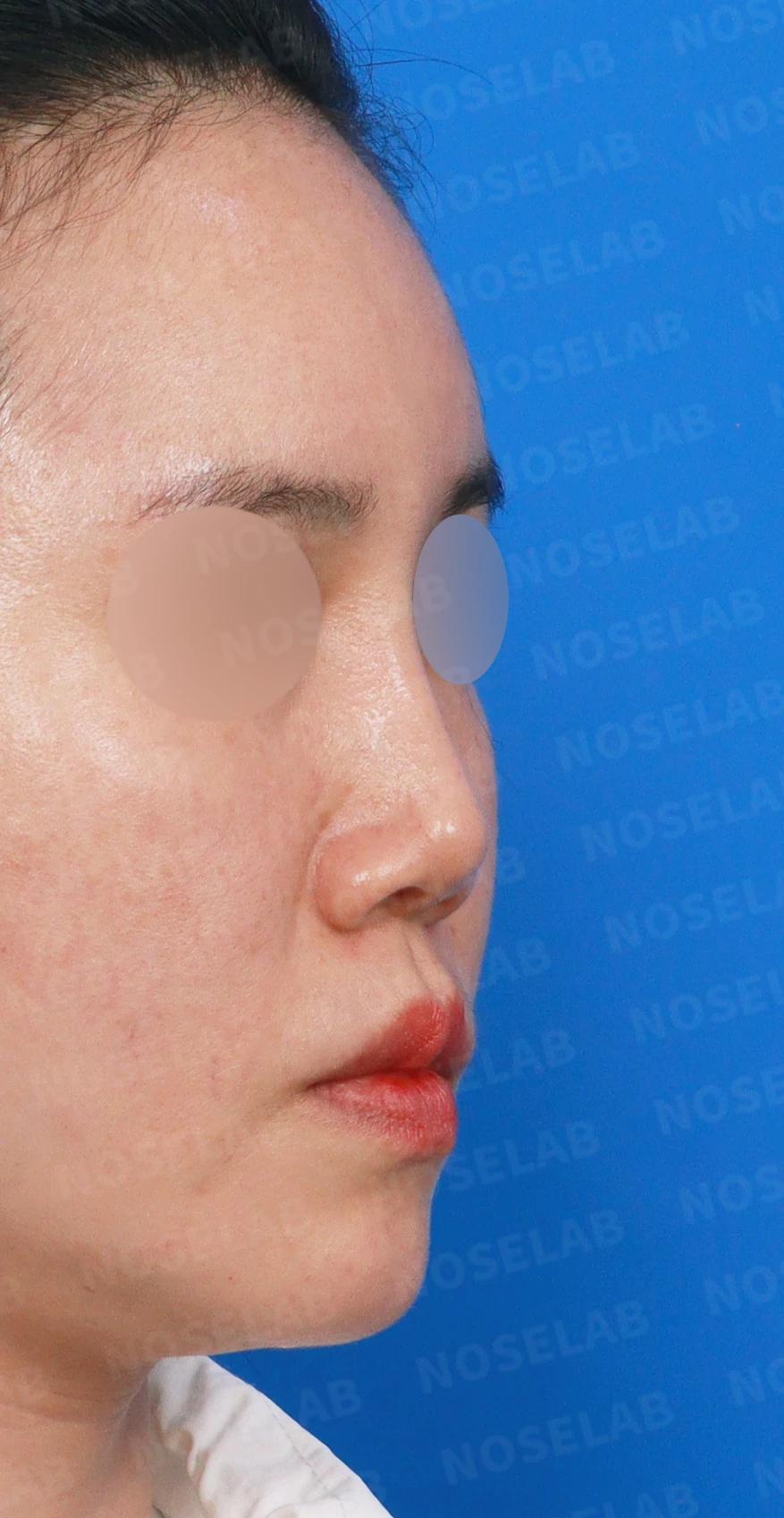 메드포어를 넣은 코에 코막힘이 생기는 이유, 제거와 자가늑연골 비중격 재건은 어떻게 하나 — 디자인 상담 우측 측면, 비스듬한 측면, 비공 사진입니다.