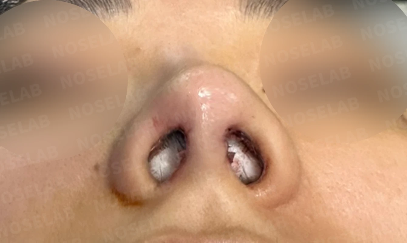 뭉툭하게 퍼진 코끝이 생기는 이유, 자가 늑연골 비중격 연장으로 직반 라인을 만드는 방법 — 본문 사진 20