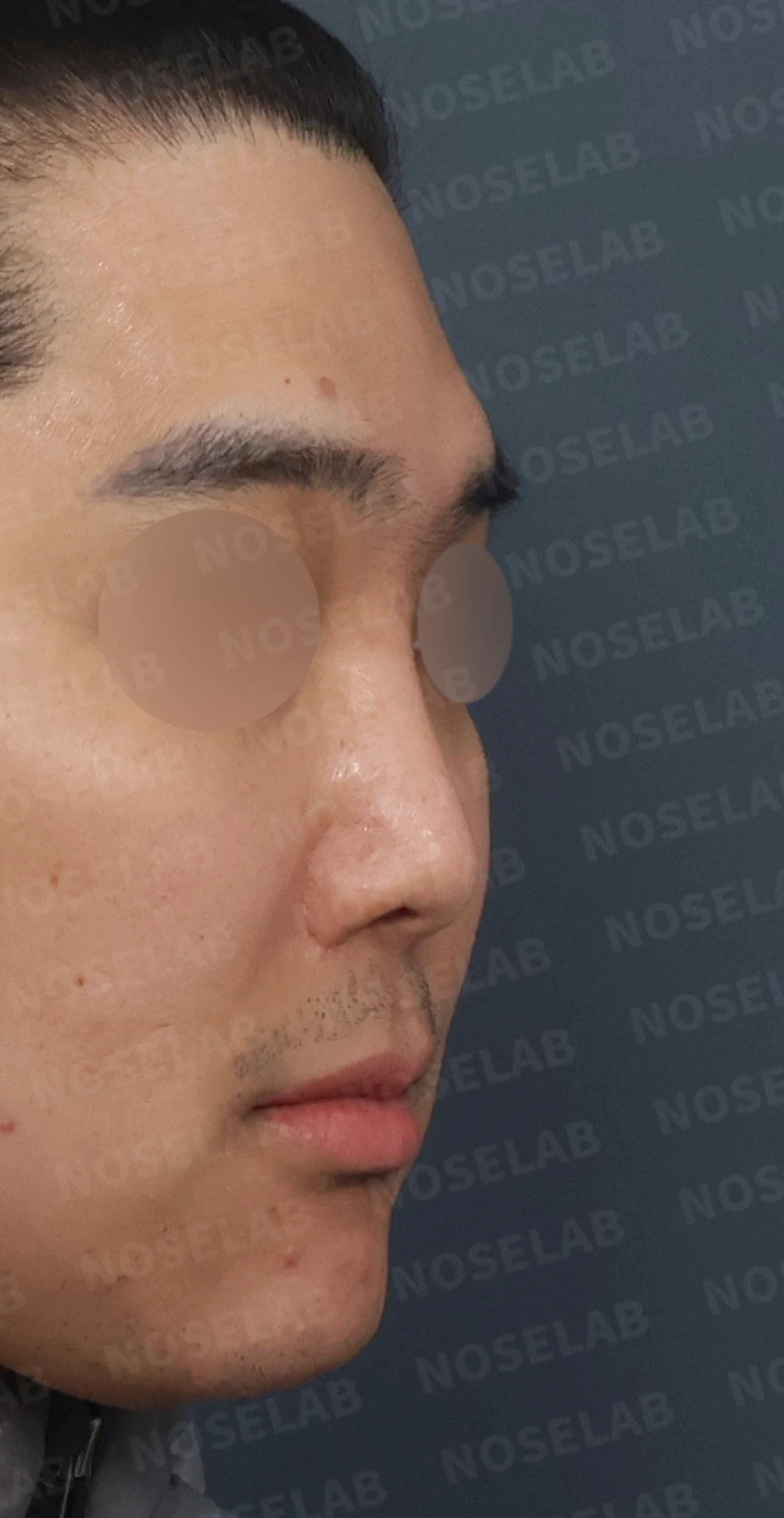 휜코 교정과 비공 비대칭, 자가늑연골로 바로잡은 코재수술 — 디자인 상담 우측 측면, 비스듬한 측면, 비공 사진입니다.