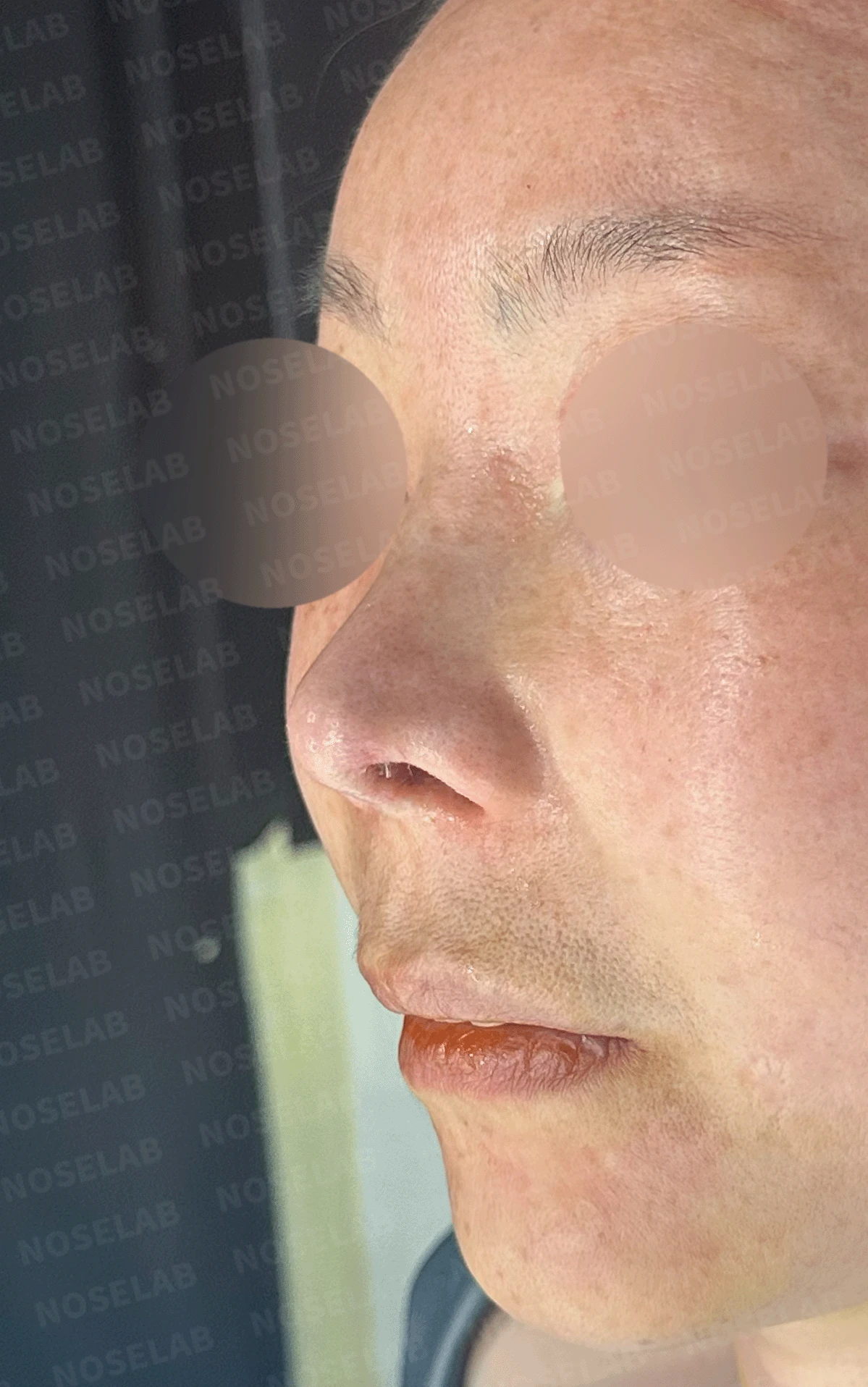 코가 짧고 들리며 비주가 함몰되는 이유, 자가 늑연골 재건은 어떻게 하나 — 본문 사진 13