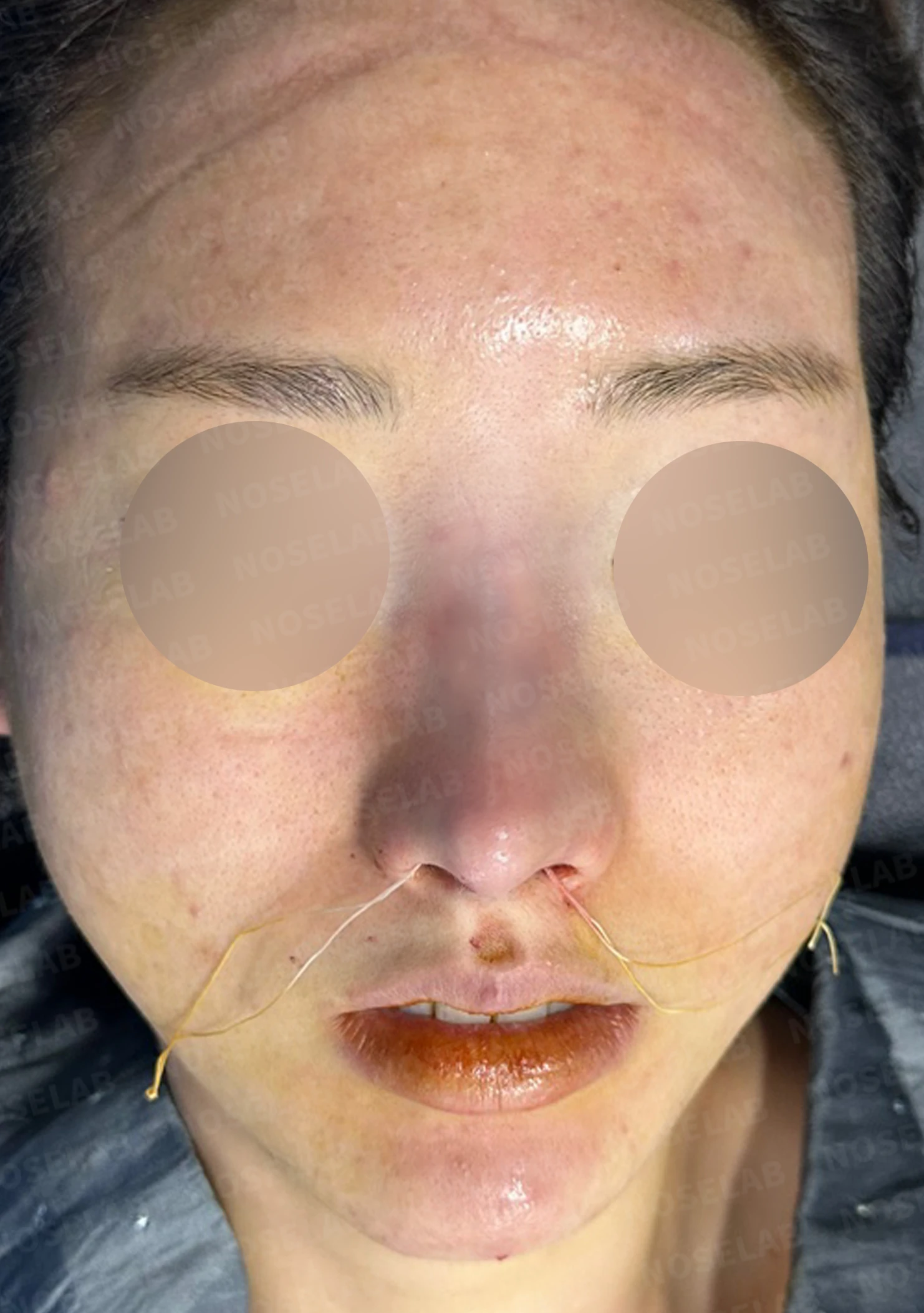 코 필러 뒤에도 휜 코와 코막힘이 남는 이유, 교정은 어떻게 하나 — 수술 전 / 수술 직후 0일 직후 사진은 부기가 있는 상태로 최종 결과와 다를 수 있습니다.