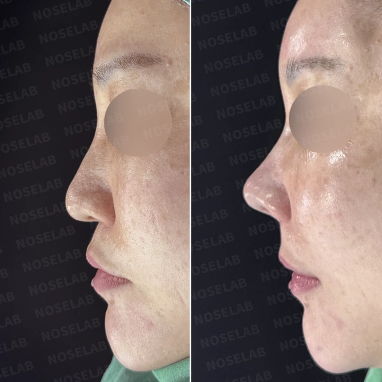 석회화된 늑연골로 완성한 자연스러운 코, 중안면부 교정까지 — 전후 비교