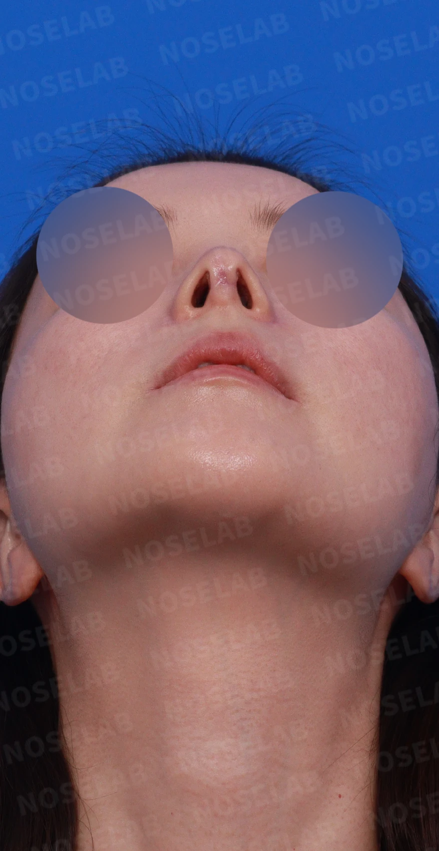 코성형 후 남는 미세한 높이 부족과 좌우 비대칭, 왜 생기고 어떻게 보강하나 — 디자인 상담 우측 비스듬한 측면 , 측면 , 비공 사진입니다.