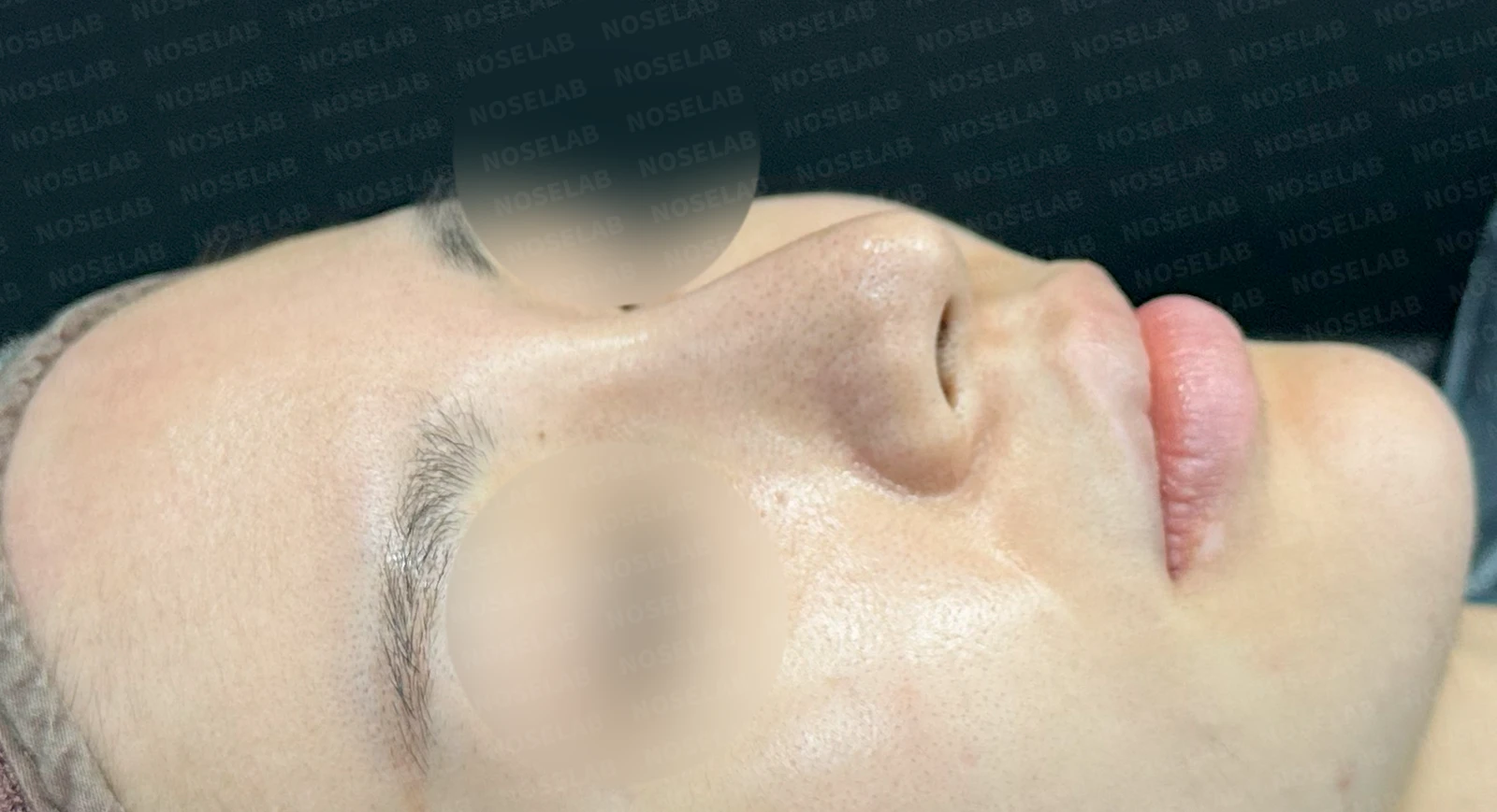 여러 코 모양 고민을 함께 살펴보는 코성형 계획 — 수술 전 / 수술 직후 0일 직후 사진은 부기가 있는 상태로 최종 결과와 다를 수 있습니다.