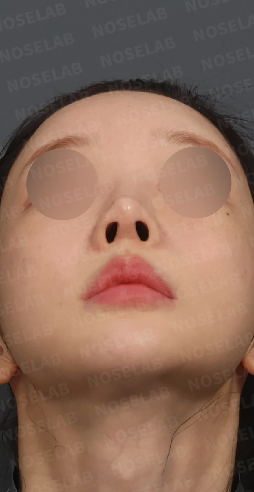 여러 차례 코수술 후 자가늑연골과 자가진피로 코 전체를 자연스럽게 높인 재수술 — 디자인 상담 우측 측면, 비스듬한 측면, 비공 사진입니다.
