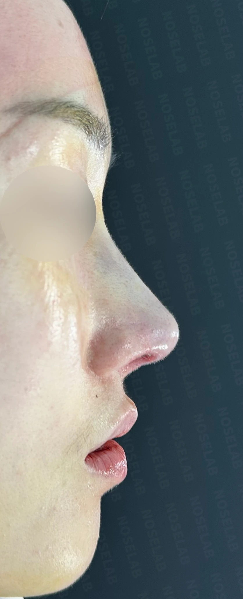 수술한 티가 나는 코의 무보형물 재수술 방법 — 수술 직후 0일 사진 90도, 45도, 정면 직후 사진은 부기가 있는 상태로 최종 결과와 다를 수 있습니다.
