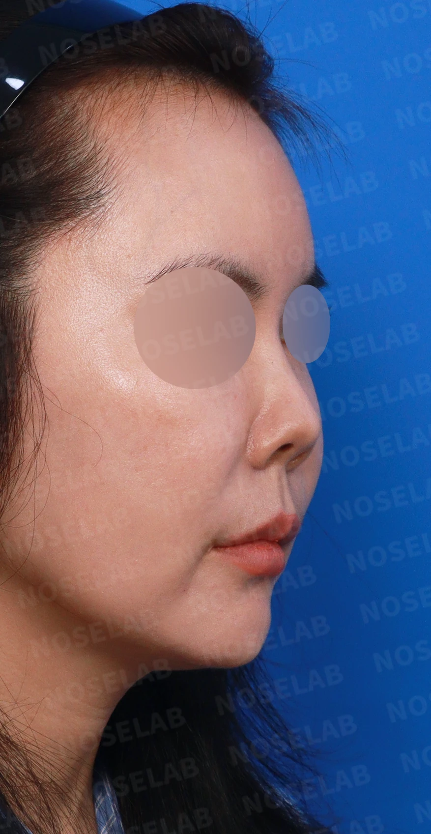 L자 실리콘 보형물이 비주 점막을 뚫기 직전까지 가는 이유, 제거와 자가늑연골 재건 방법 — 디자인 상담 우측 측면, 비스듬한 측면, 비공 사진