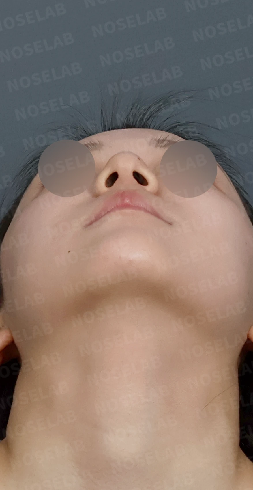 코필러 제거 후 자가늑연골 코성형, 처진 코끝과 메부리코를 자연스럽게 교정 — 디자인 상담 우측 측면, 비스듬한 측면, 비공 사진입니다.