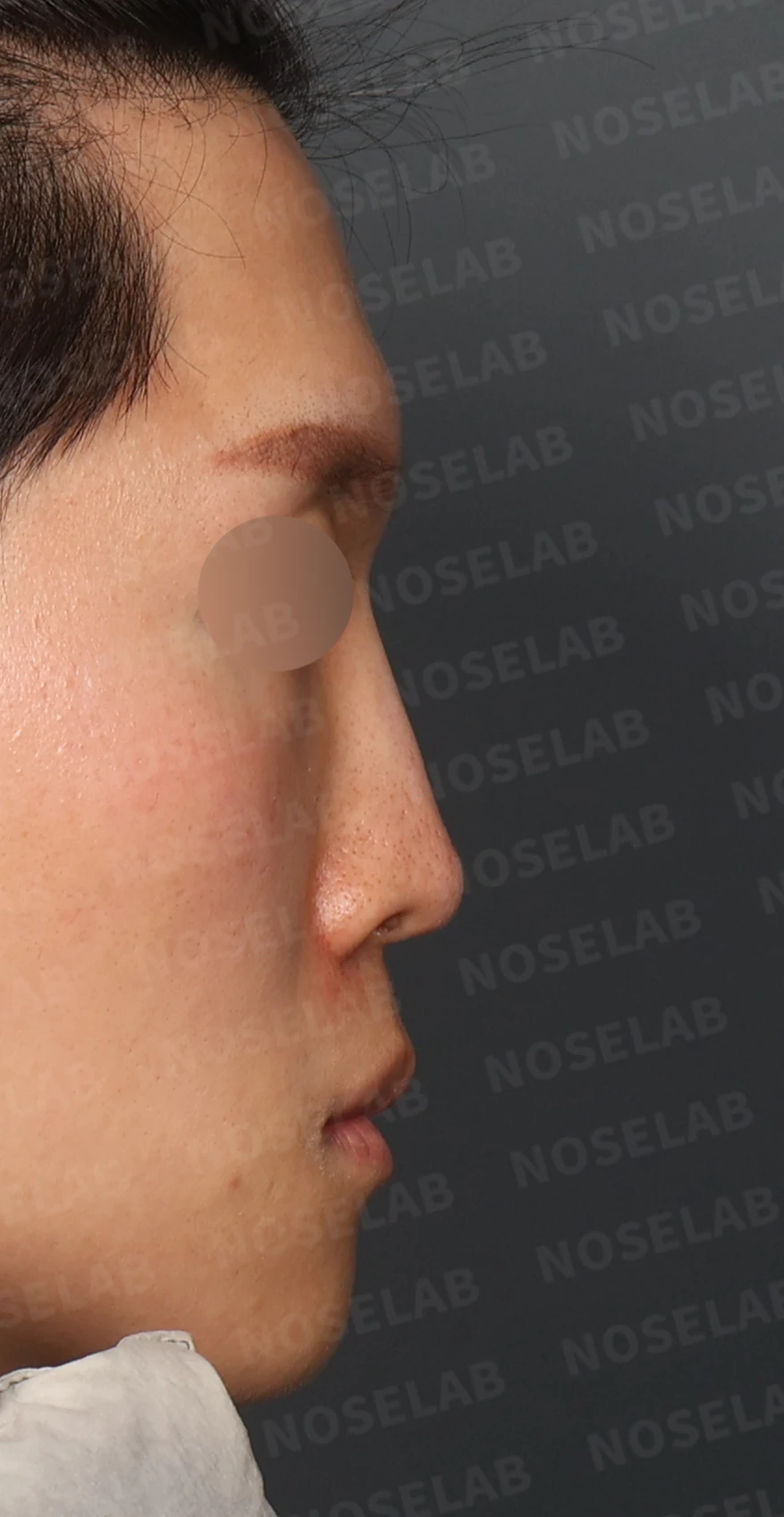 2차 코재수술, 자가늑연골로 비중격 재건과 직선 코 라인 완성 — 디자인 상담 우측 측면, 비스듬한 측면, 비공 사진