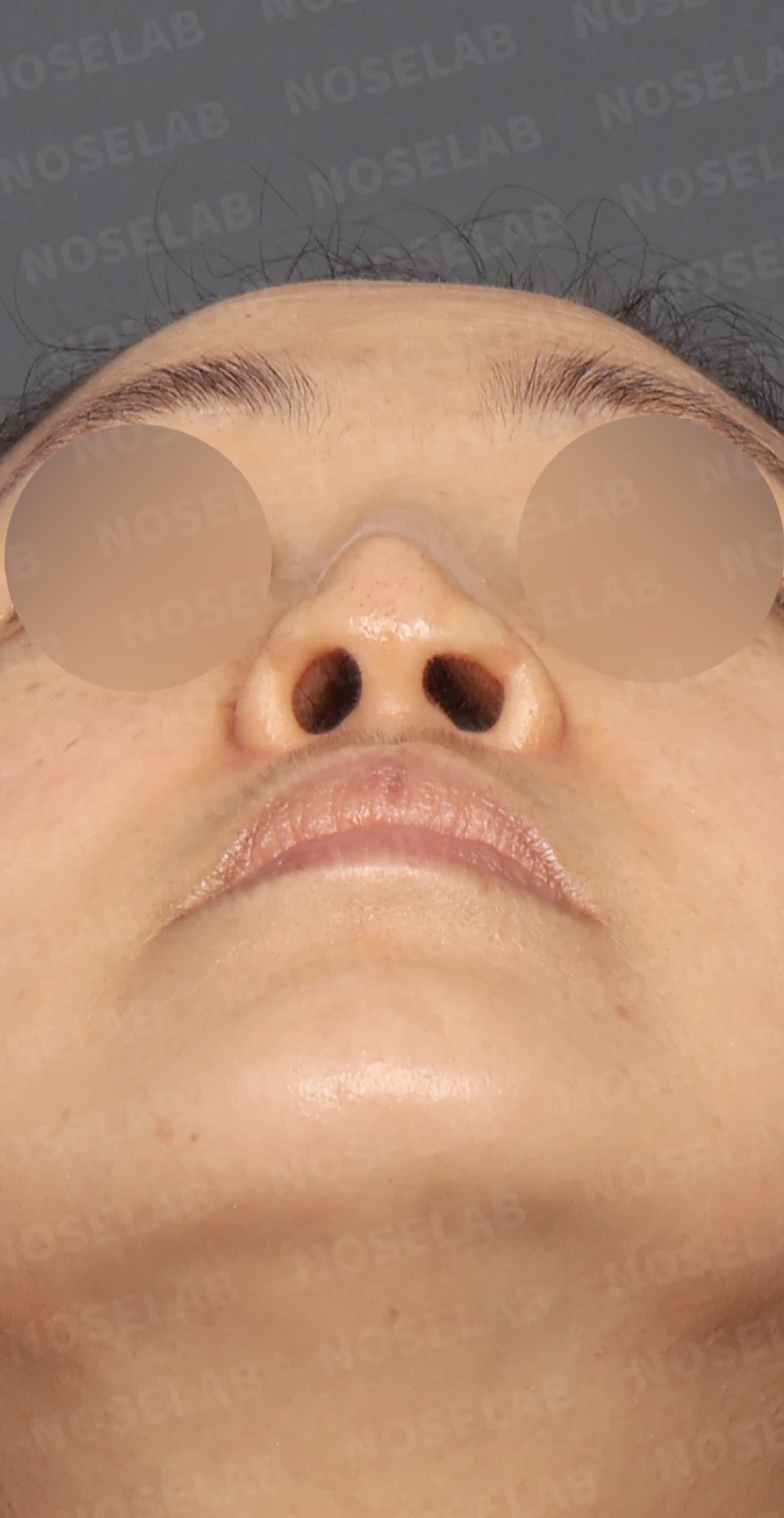 보형물 비침과 용코, 자가늑연골로 안전하게 교정한 코재수술 — 디자인 상담 우측 측면, 비스듬한 측면, 비공 사진입니다.